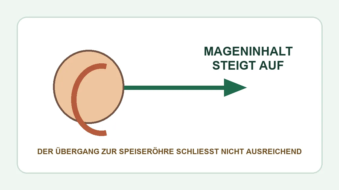 Corona Sodbrennen – Mageninhalt steigt beim Reflux in die Speiseröhre auf.